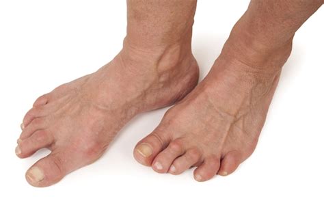 sağ ayak bileğinin artriti böyle bir hastalık nasıl tedavi edilir